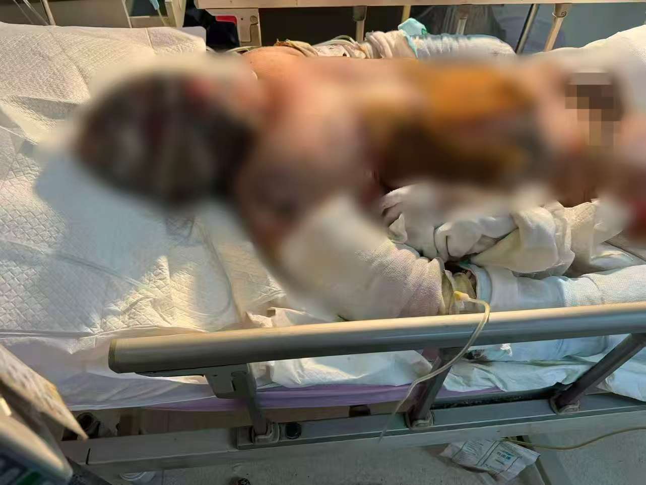 父子在哈尔滨一亲戚公司上班遇爆炸全身烧伤,治疗花费近百万公司拒赔偿?亲戚回应